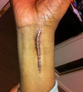 Right wrist post surgery