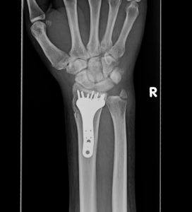 XRAY of arm post surgery