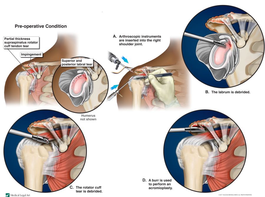 Steven's shoulder surgery