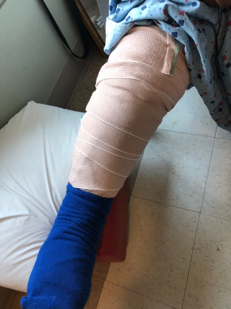 Karla brooklyn burn injury